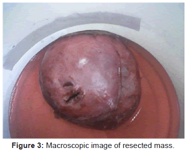 pediatrics-therapeutics-macroscopic-resected-mass