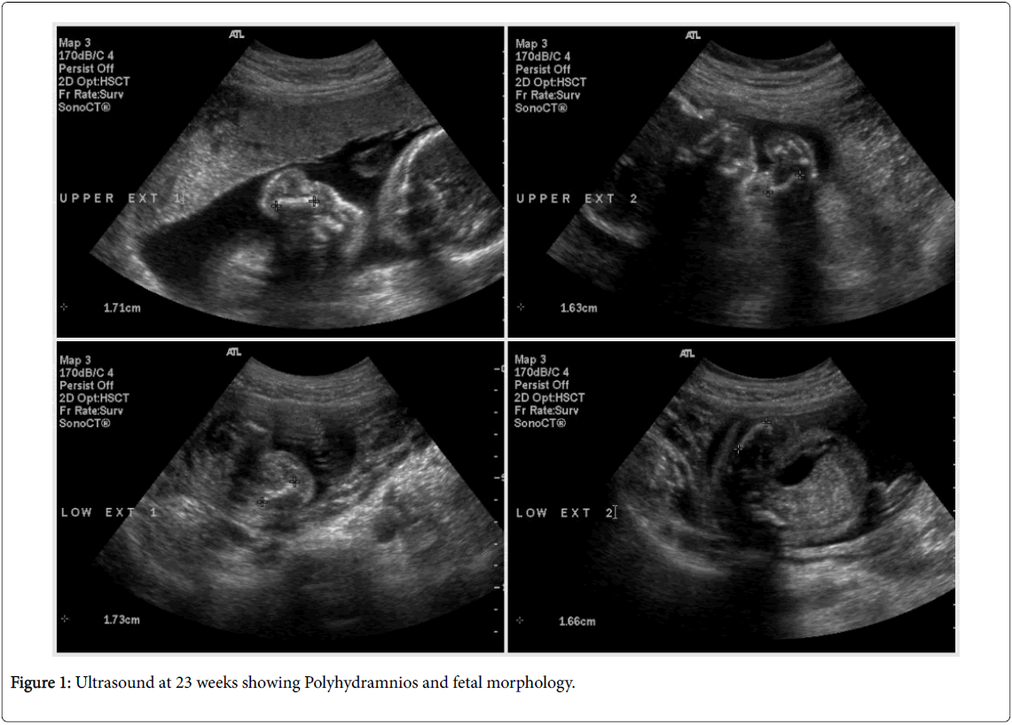 pediatrics-therapeutics-ultrasound-showing-polyhydramnios