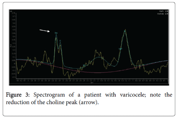 reproductive-system-sexual-disorders-Spectrogram-patient-varicocele