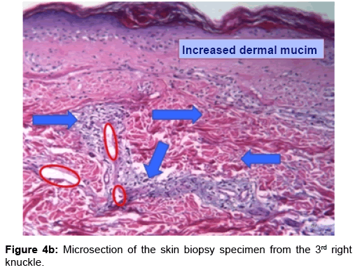 rheumatology-Microsection-skin-biopsy