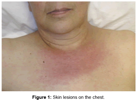 rheumatology-Skin-lesions-chest