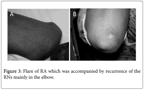rheumatology-current-Flare-elbow
