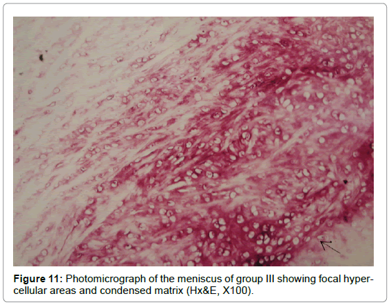 rheumatology-current-focal-hypercellular