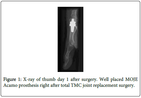 rheumatology-current-thumb-surgery