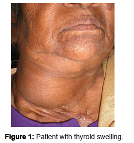 thyroid-disorders-therapy-Patient-thyroid-swelling