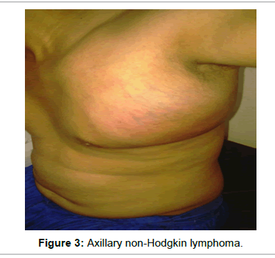 tumor-diagnostics-reports-Hodgkin-lymphoma