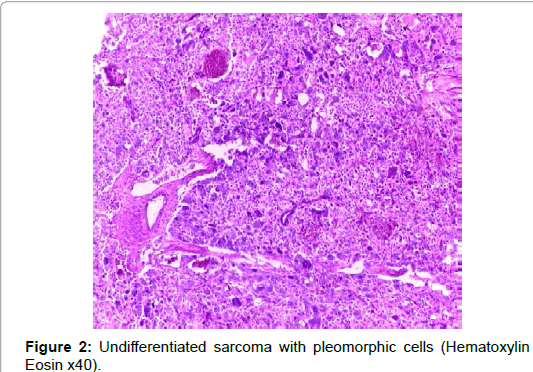 tumor-diagnostics-reports-Undifferentiated-sarcoma