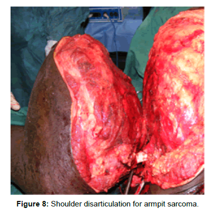 tumor-diagnostics-reports-armpit-sarcoma