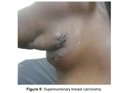 tumor-diagnostics-reports-breast-carcinoma