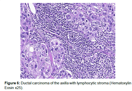 tumor-diagnostics-reports-lymphocytic-stroma