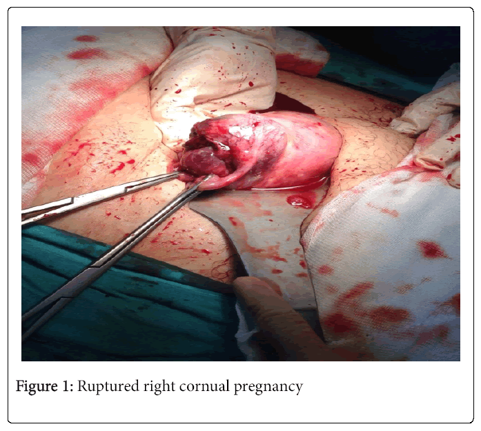 Womens-Health-Ruptured-right-cornual-pregnancy